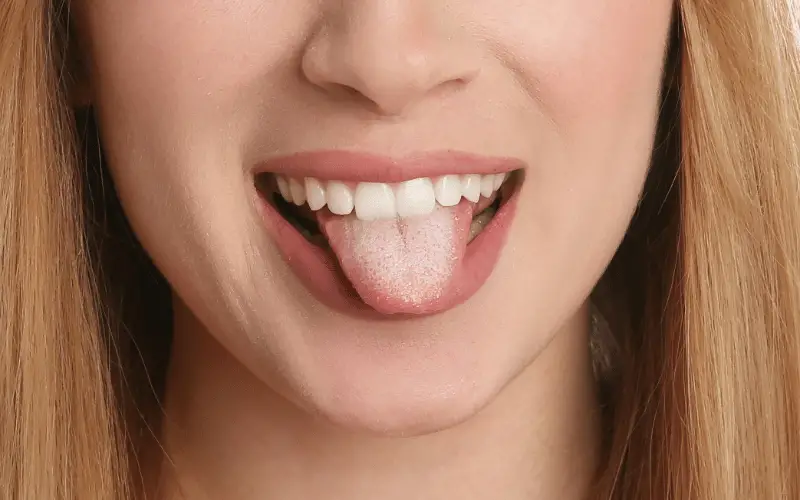 White Patches on the Tongue