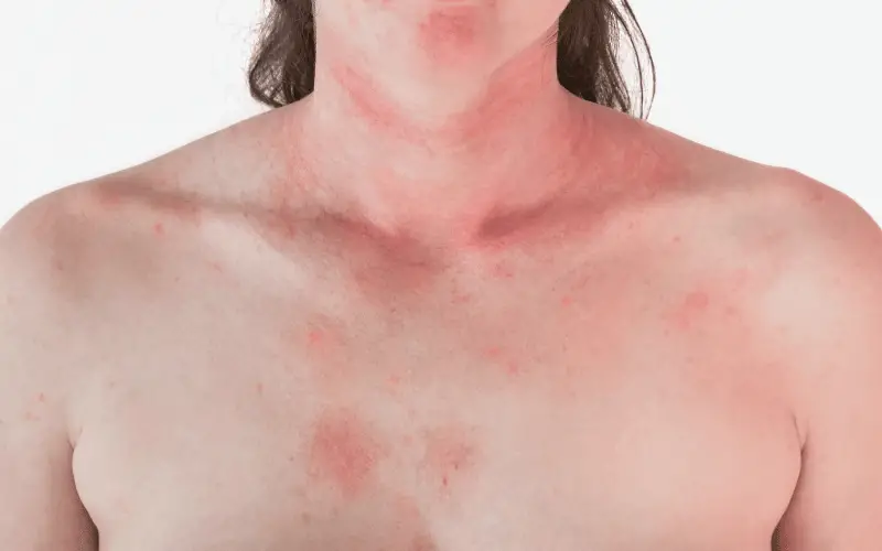 Widespread Red Rashes