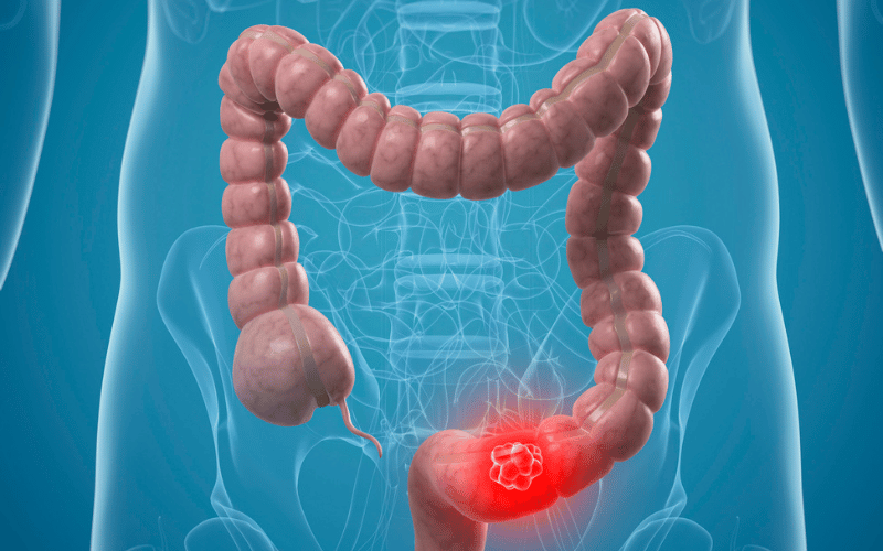 10 Revealing Symptoms of Sessile Serrated Lesions What to Watch Out For