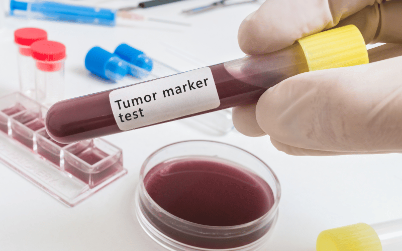 Krukenberg Tumor Symptoms The Top 10 Indicators