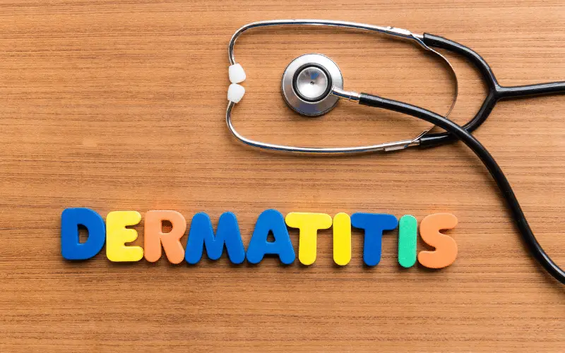 Recognize Perioral Dermatitis The 10 Symptoms Unmasked