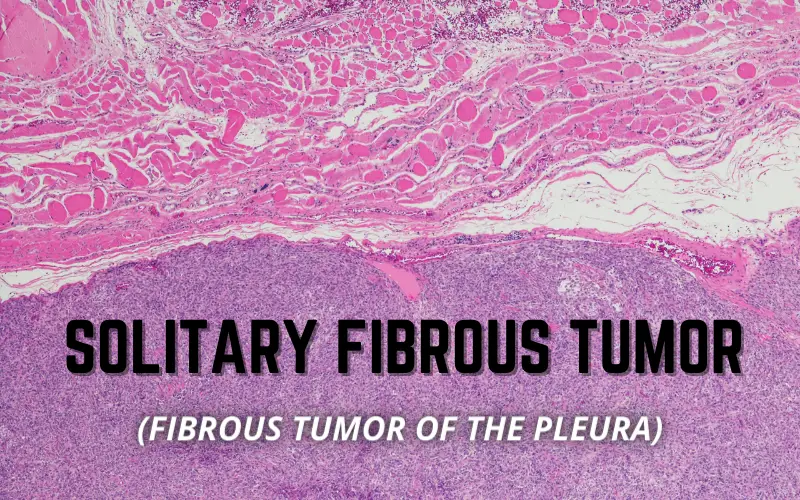 Solitary Fibrous Tumor 10 Key Symptoms That Signal a Check-Up