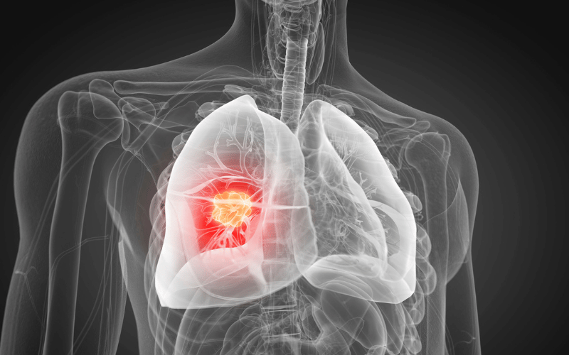 What Causes Lung Cancer Uncovering the Top 10 Triggers