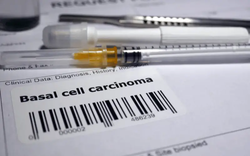What to Expect 10 Facts About Basal-Cell Carcinoma Prognosis
