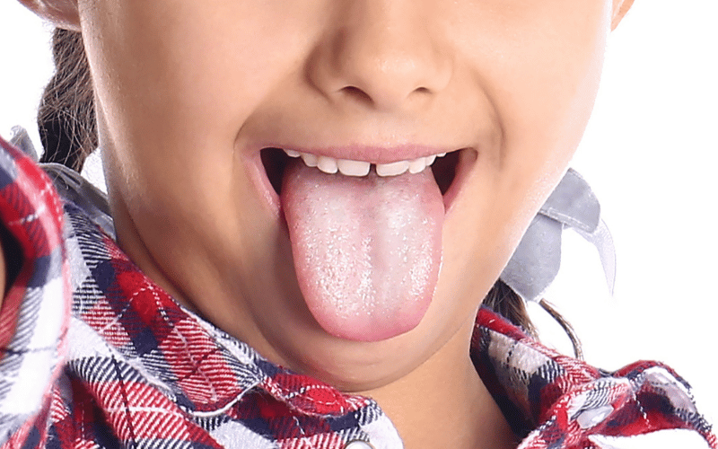 When to Worry 10 Oral Thrush Symptoms in Children You Should Know