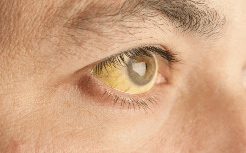 Jaundice The Hallmark Symptom You Can't Afford to Ignore