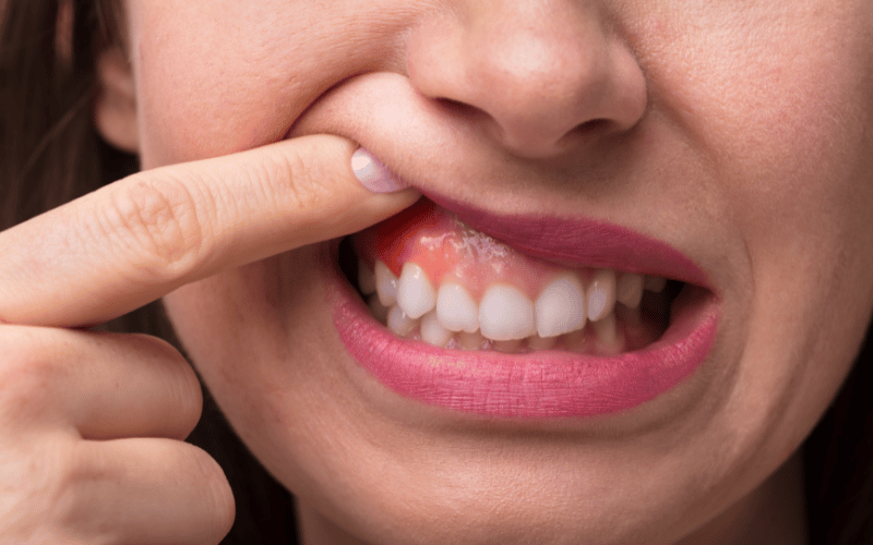 Swelling in the Gums The First Red Flag of Noma Disease