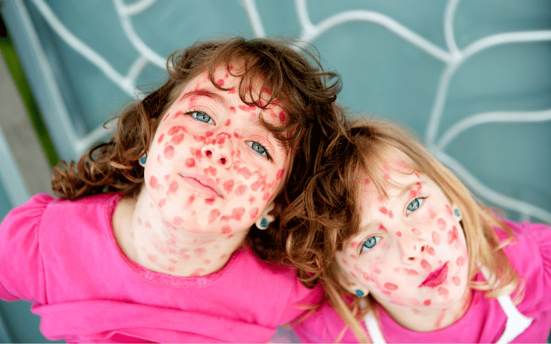 Understanding Measles at Its Core Not Just a Simple Rash