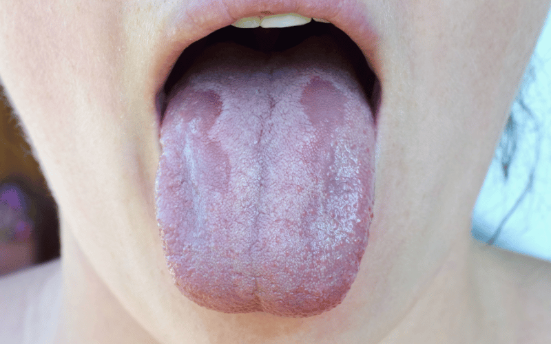 White Patches on the Tongue and Inside Cheeks The Classic Marker of Oral Thrush