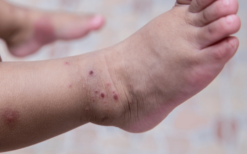 10 Alarming Symptoms of Hand, Foot, and Mouth Disease (HFMD) You Shouldn't Ignore