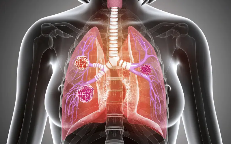 10 Alarming Symptoms of Lung Cancer in Women You Shouldn't Ignore