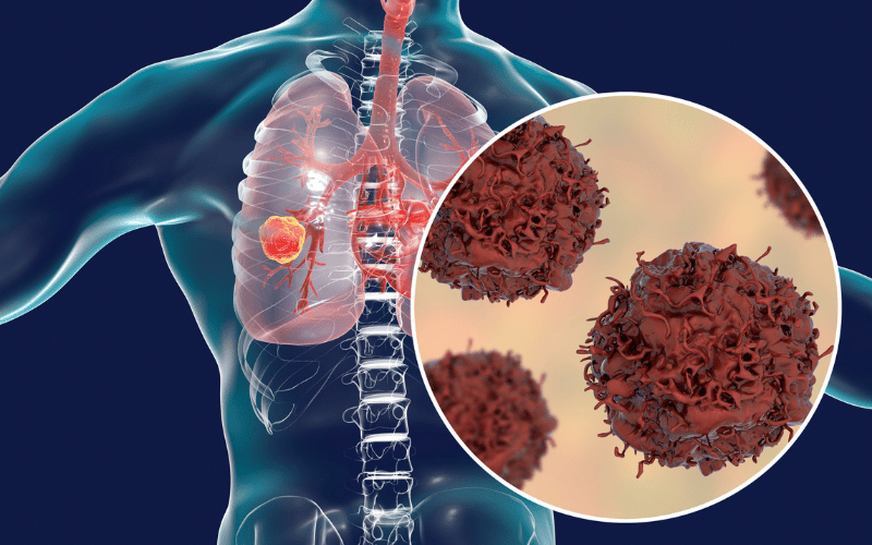 10 Critical Facts About Radon Gas and Lung Carcinoma