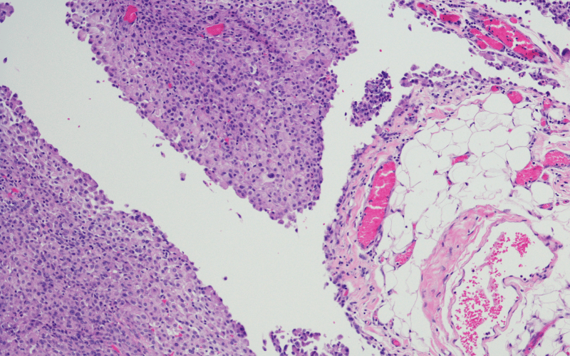 10 Crucial Facts About Peritoneal Mesothelioma Life Expectancy