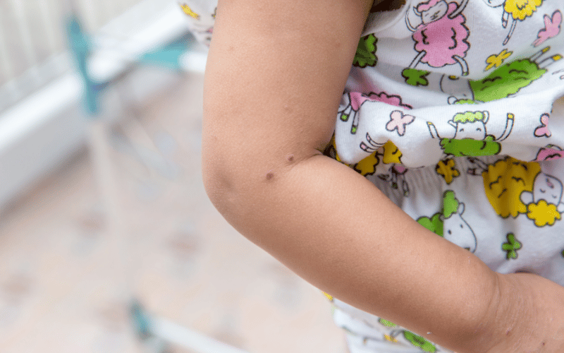 10 Telltale Symptoms of Hand, Foot, and Mouth Disease (HFMD) in Children