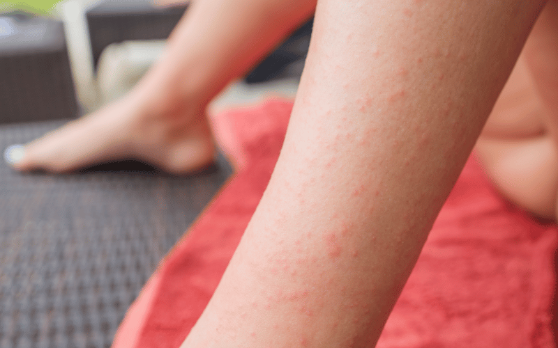 Skin's Hidden Secrets Dermatitis Herpetiformis and Celiac