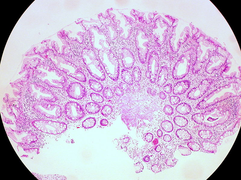 Hyperplastic Polyps Innocuous but Not to be Ignored