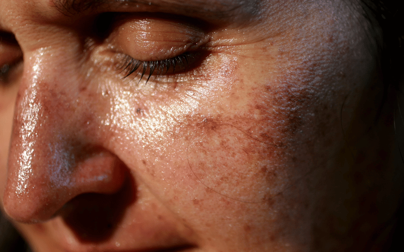 Mucocutaneous Pigmentation More Than Just Skin Deep