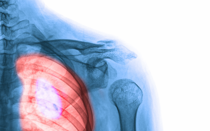 4-types-of-lung-carcinoma-a-look-into-the-most-common-variants-page
