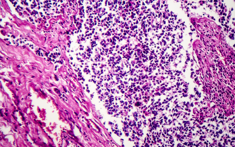 Histological Types Why the Microscopic Matters