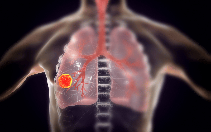 Lung Carcinoid Tumor The Slow-Moving Enigma