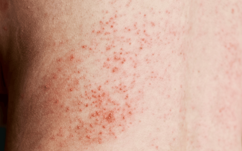 Skin Rash Chikungunya's Visible Marker