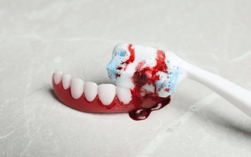 Bleeding Gums The Noma Factor in Dental Health