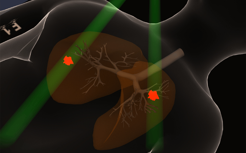 Large Cell Neuroendocrine Tumors The Rare Complexity