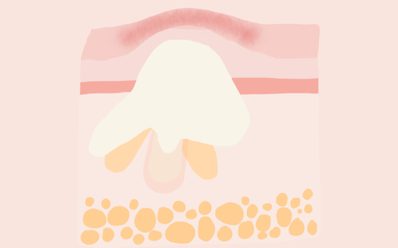 Sporadic Pustules When Bumps Turn into Little Volcanoes