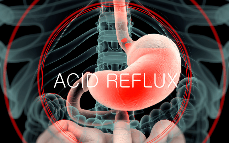 Acid Reflux An Unexpected but Troubling Side Effect