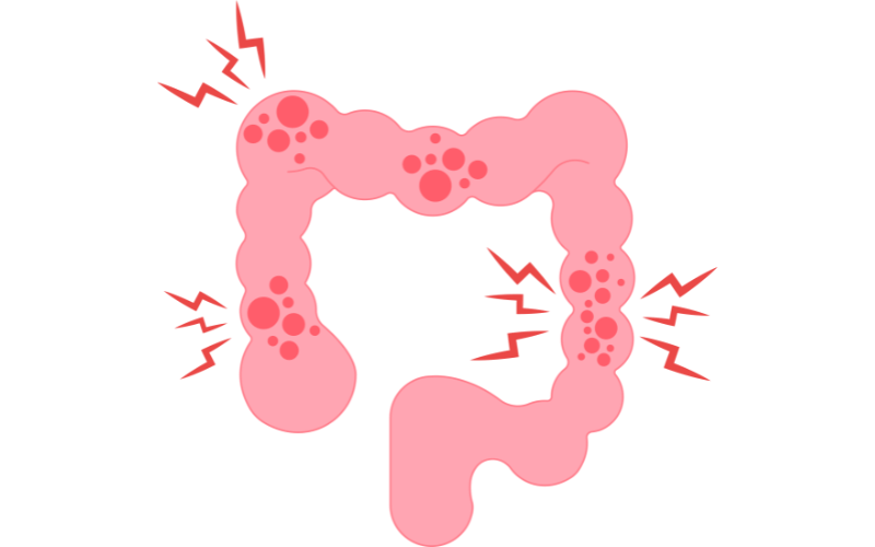 Change in Bowel Habits When Routine Takes a Twist