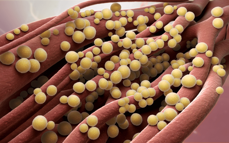 The Staphylococcus Saga Food Poisoning Turned Gastroenteritis