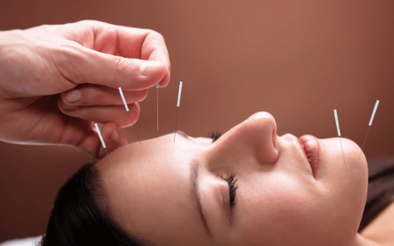 Ancient Wisdom The Benefits of Acupuncture