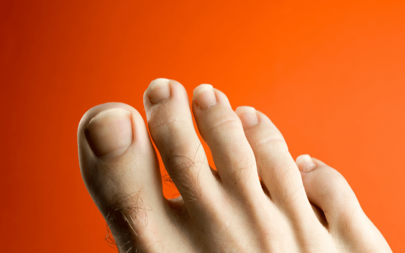 Clubbing of Fingers and Toes The Subtle Extremity Change