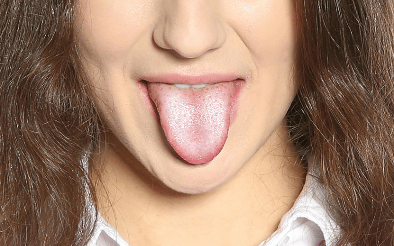 A Deeper Dive into Oral Thrush