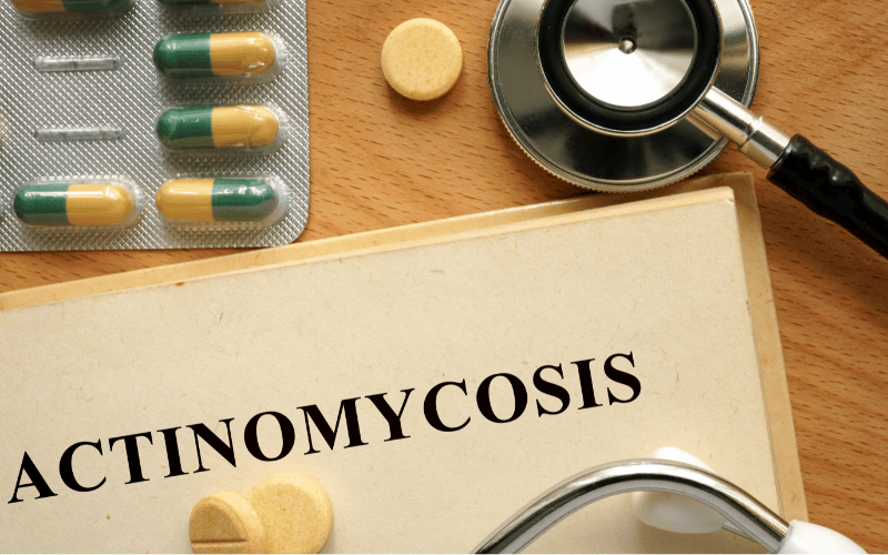 Actinomycosis Symptoms Navigating the Maze of this Intricate Infection