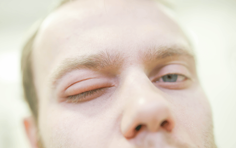 Angioedema (Quincke's Edema) Delving Deep into its Three Types