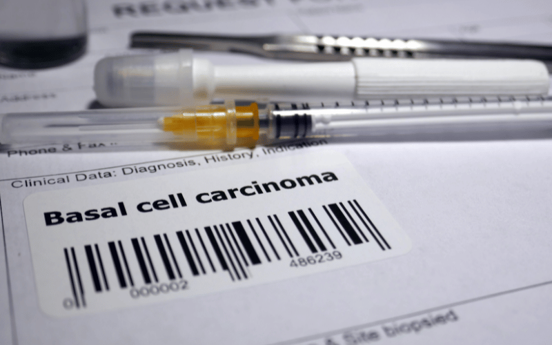 Demystifying Basal-Cell Carcinoma