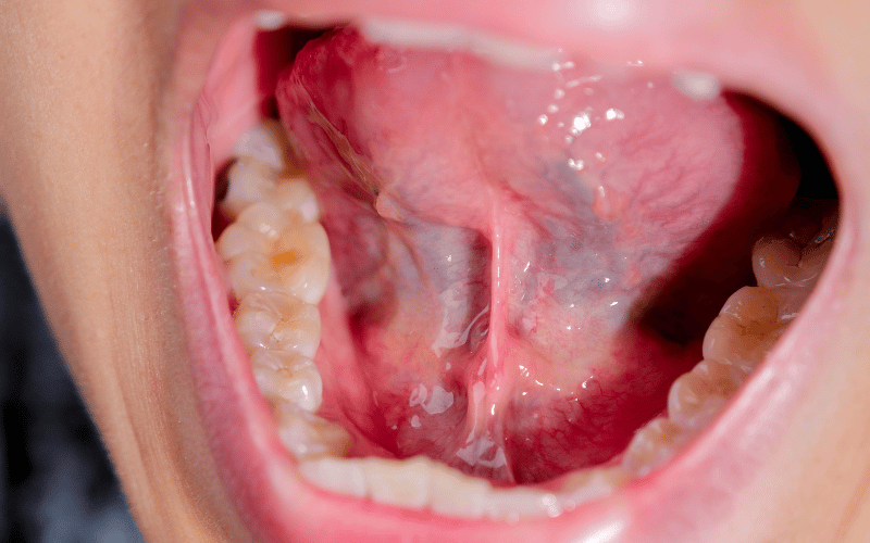 Elongated Uvula and Soft Palate The Anatomical Orchestra