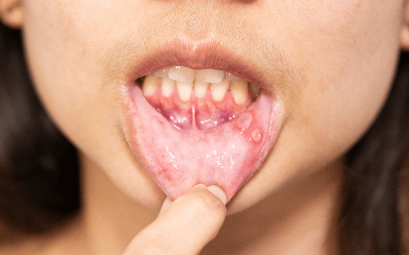 Frequent Mouth Ulcers or Sores The Underestimated Warning