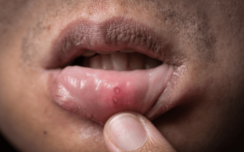 Limited Occurrence Inside the Mouth