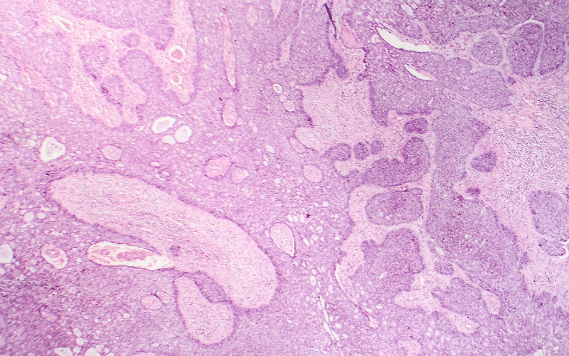 Morpheaform Basal-Cell Carcinoma The Stealthy Invader