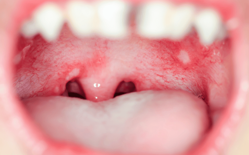 Mouth Ulcers