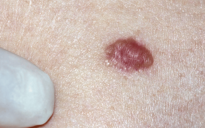 Nodular Basal-Cell Carcinoma The Deceptive Bump