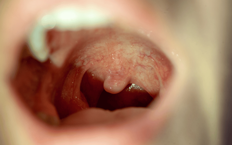 Red Spots with Blue-White Centers Measles’ Telltale Sign Inside the Mouth