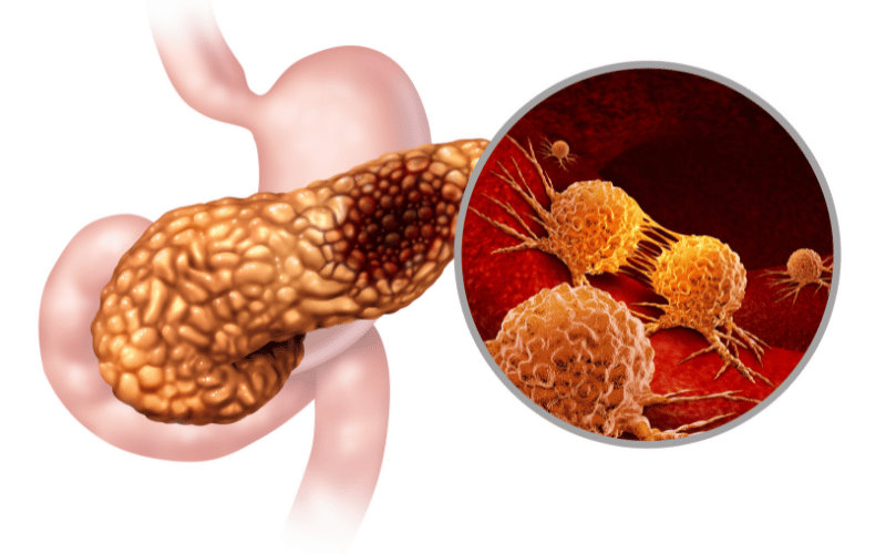 Risk Factors of Stomach Cancer Revealing Gastric Perils