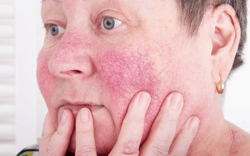 Skin Disorders