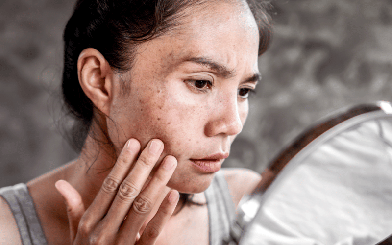 Skin Lesions More Than Just a Cosmetic Concern