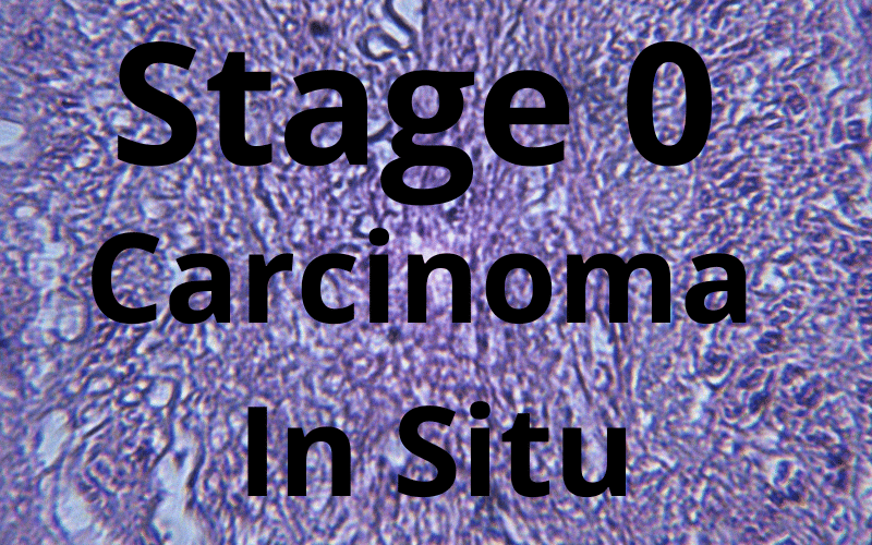 Stage 0 (Carcinoma In Situ) The Onset