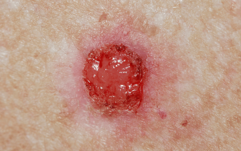 Superficial Basal-Cell Carcinoma The Reddish Masquerader