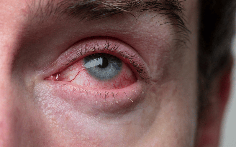 Swollen Eyelids The Window to Inflammation